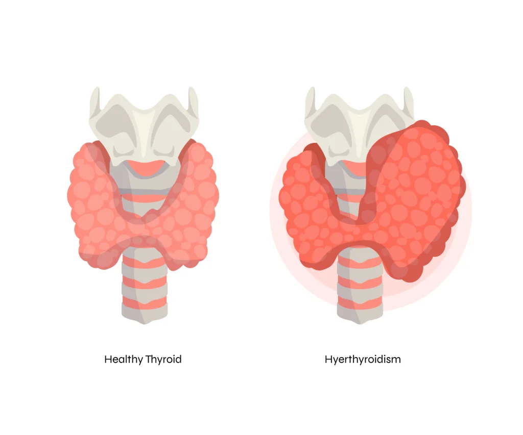 hyperthyroidism 